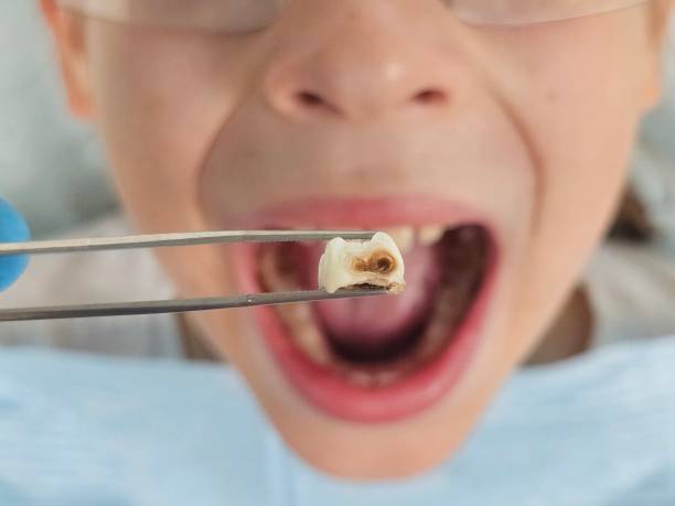 Best Dentist for Tooth Abscess  in Oakwood, GA